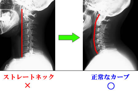 ストレートネック