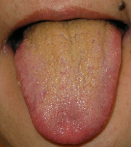 紅舌2