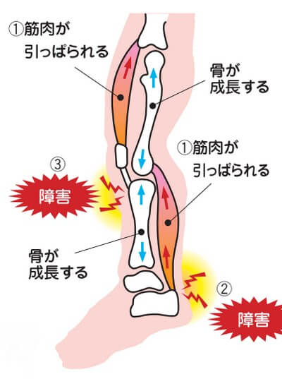 成長痛の仕組み　引用