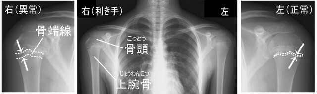 上腕骨骨端線離開（リトルリーガーズショルダー）　引用