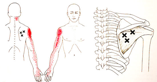 棘下筋トリガーポイント