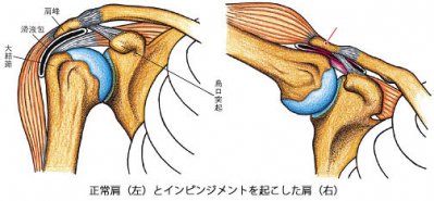 インピンジメント症候群　引用