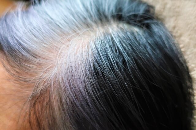 白髪は抜くべきか抜かぬべきか、中医学から診る３つの分類分け