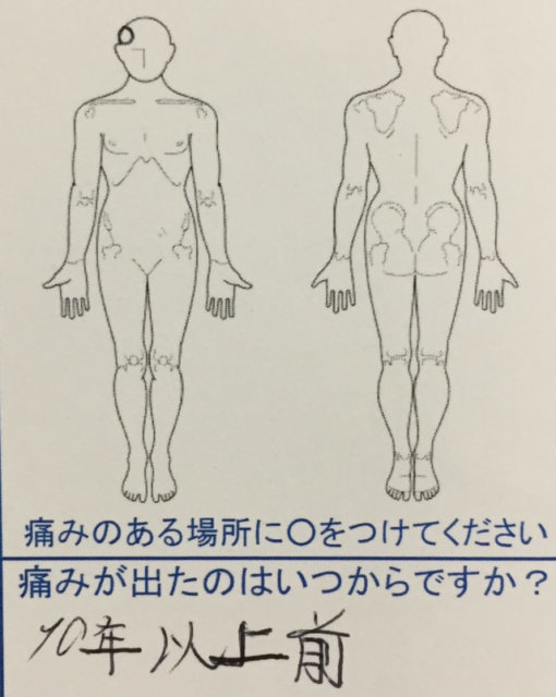 10年以上続く慢性右側の頭痛が整体鍼灸で劇的によくなった50代男性の一症例