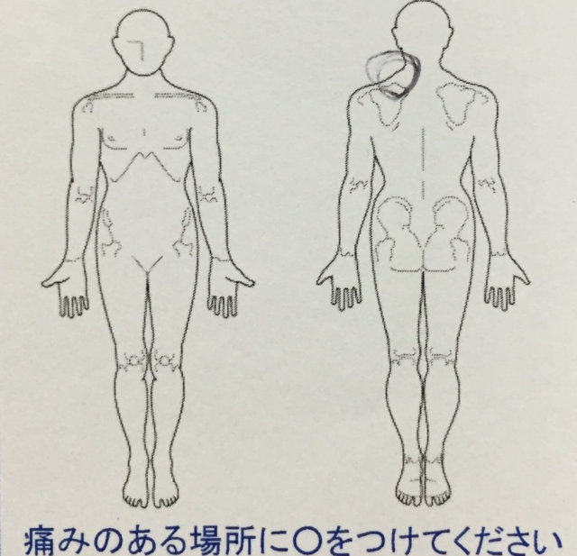 育児中のママ、子供の抱っこで左首肩が鋭く痛む一症例