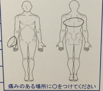 右手首の痛み【手術しないと完治しないと言われた】整体鍼灸治療で治った40代女性の1症例