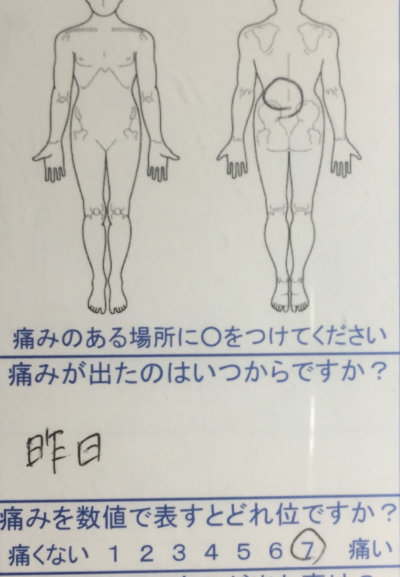 昨日ぎっくり腰で激しい痛み【じわじわ5日前から痛かった】鍼灸治療で痛みが落ち着いた1症例