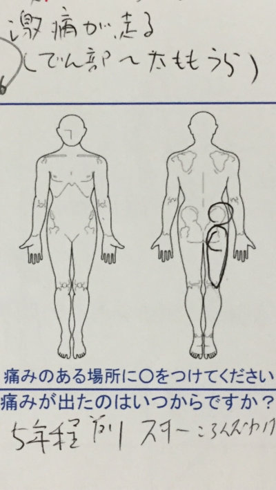 お尻からふともも裏の激痛【姿勢を変える時】5年も続く激痛が整体鍼灸治療で改善した1症例