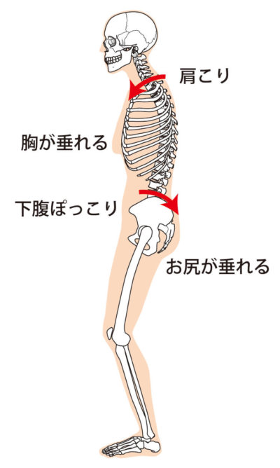骨盤後傾(猫背)