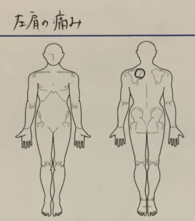 左肩の痛みとしびれ【肩甲骨間の痛み】改善した20代女性看護師の