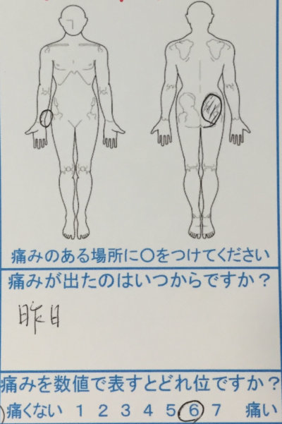 昨日から右側腰痛と後頭部の頭痛【毎週他院でマッサージ】改善せず紹介で来院された女性の症例