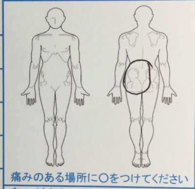 サッカー後の腰痛【1週間前から】40代男性の1症例