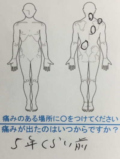 5年前から左腰ヘルニア→右首右背中の痛み40代男性の1症例