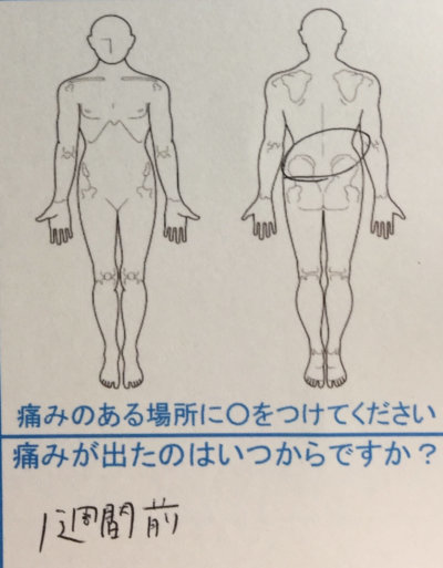 飲食業で腰痛【1週間前から】一度で改善した20代女性の1症例