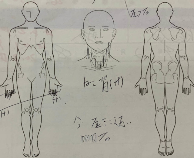 手先のしびれと肩の痛み【50代男性】整体鍼灸で解消した1症例