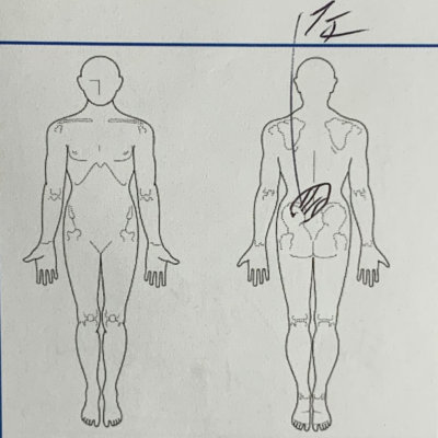 ギックリ腰になった50代男性【整体鍼灸治療】で改善した1症例