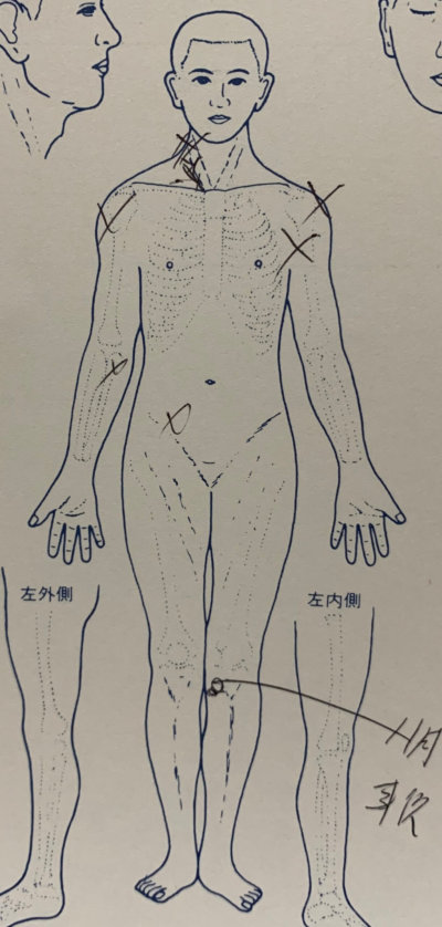 慢性的な腰痛や頭痛が1度で軽減【30代男性】の1症例